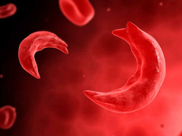 Understanding Sickle Cell Anemia: Symptoms, Causes, and Treatments